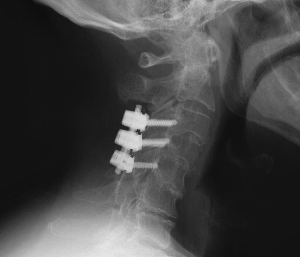 Cervical Pedicle Screws AP